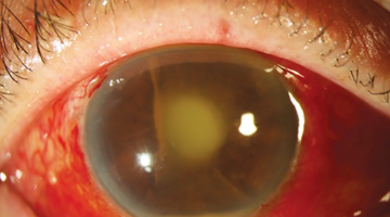 Close up of eye endophthalmitis